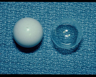 Photograph of the spherical, marble-like implants placed in the eye during eye removal surgery