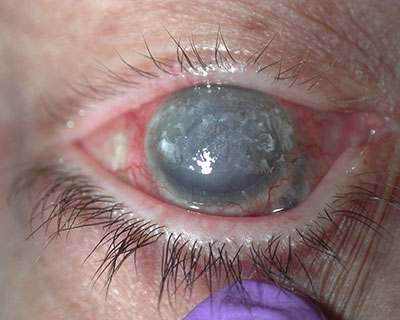 Photograph of a painful, blind eye before eye removal surgery